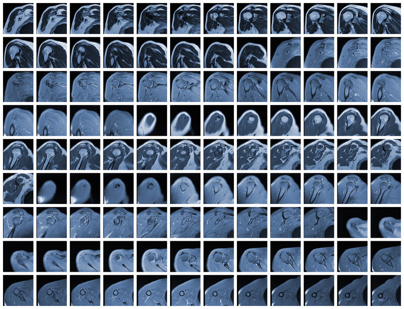 What Is A Shoulder Mri At Justin Winnie Blog