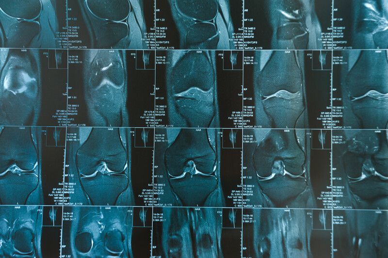 MRI of your knee and it shows degenerative arthritis