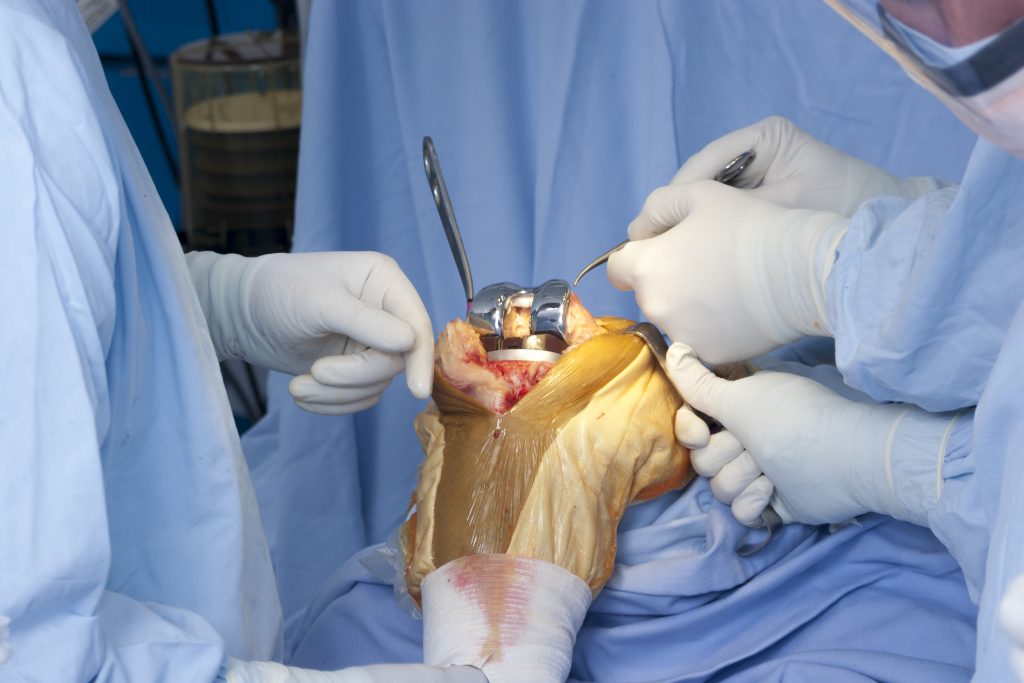 People are looking for knee replacement options
