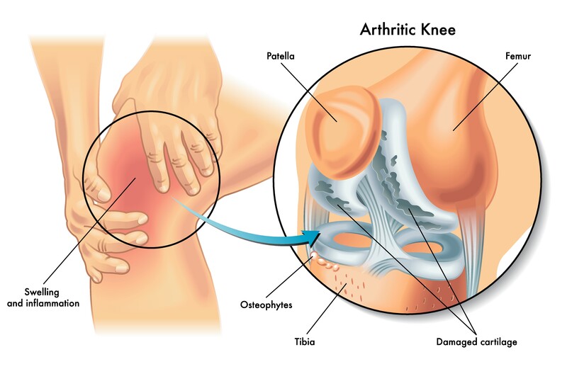 Autologous chondrocyte transplantation