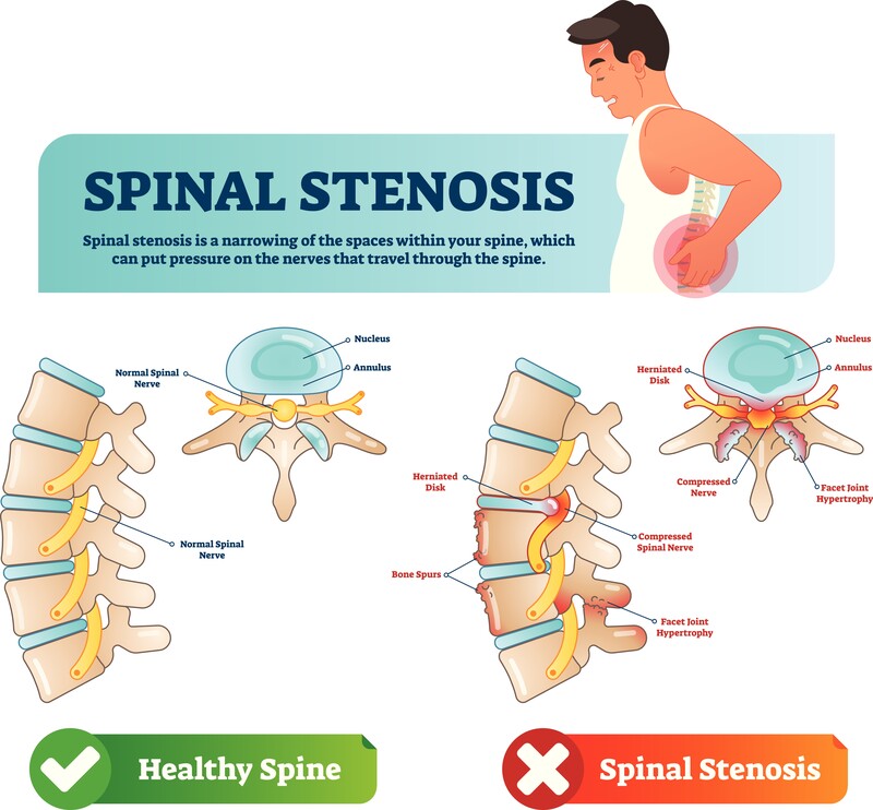 Spinal Stenosis Injections