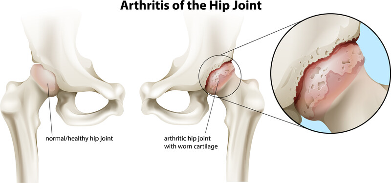 Injections and other non-surgical treatments for hip osteoarthritis