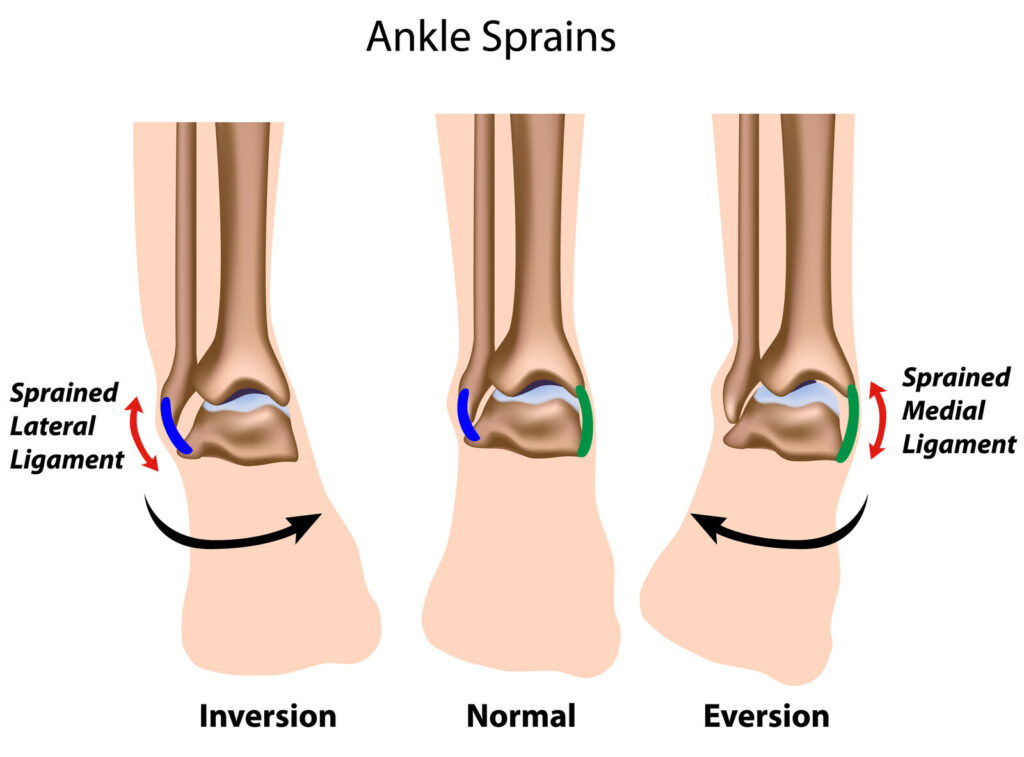 Chronic Ankle Spain Treatments