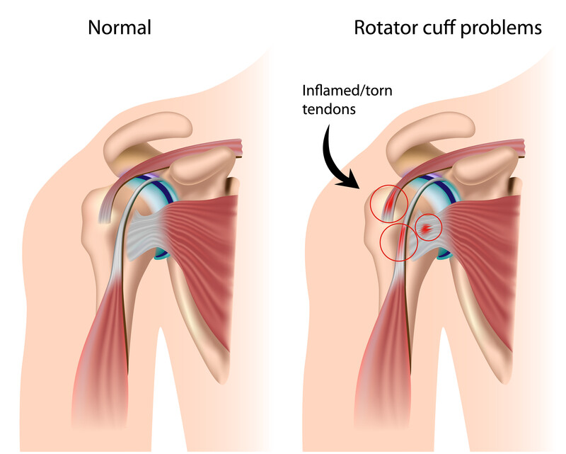 rotator cuff surgery