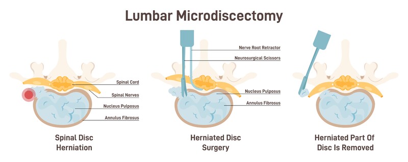 Lumbar discectomy for Lumbar Disc Herniation