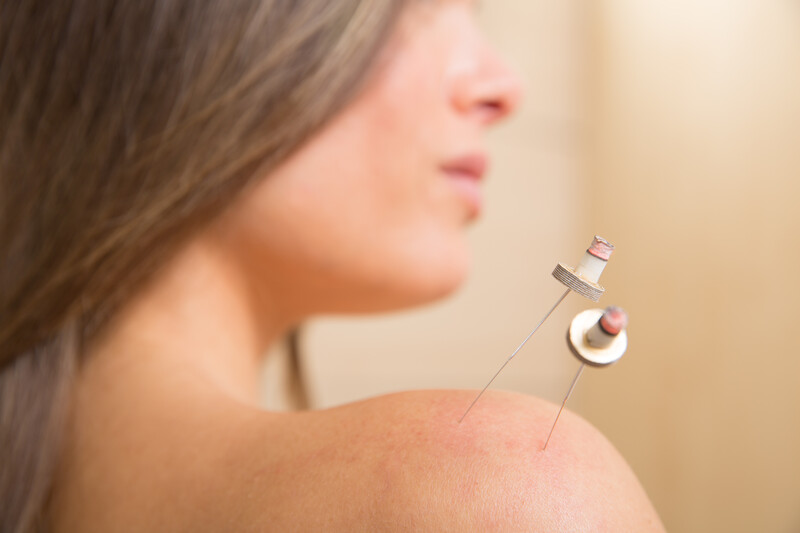 Moxibustion acupuncture needles heat on woman shoulder