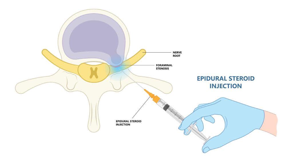 transforaminal epidural steroid injection