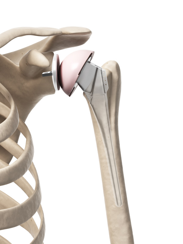 Treatment alternatives to shoulder replacement