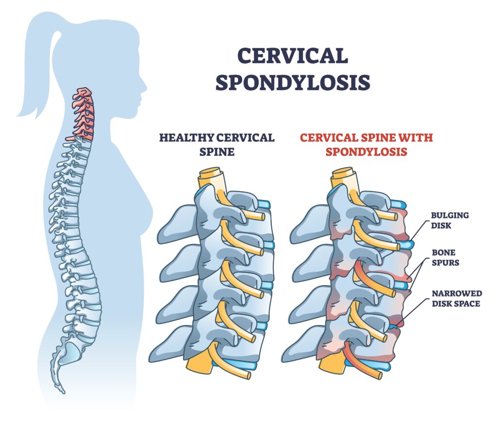 There are many different types of neck or cervical spine surgery for cervical spondylosis