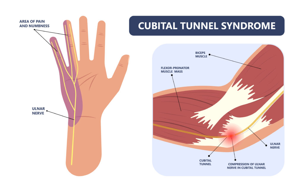 Cubital Tunnel Syndrome - Hand Health Resources